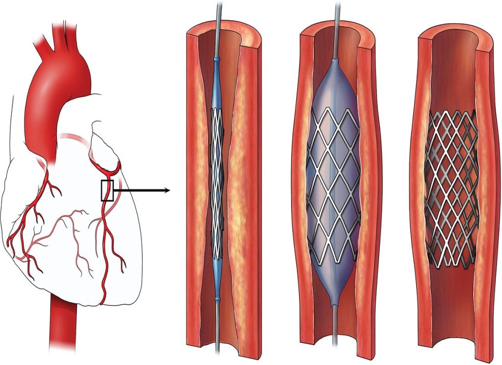 Angiography & Angioplasty $3500-$5000