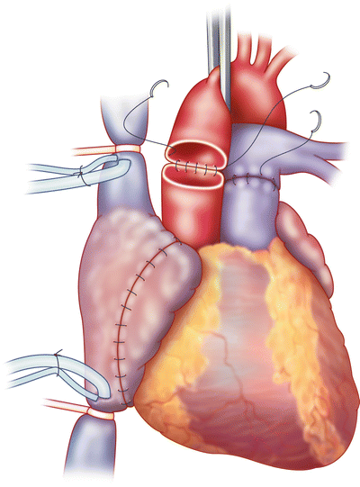 Heart Transplant $53000