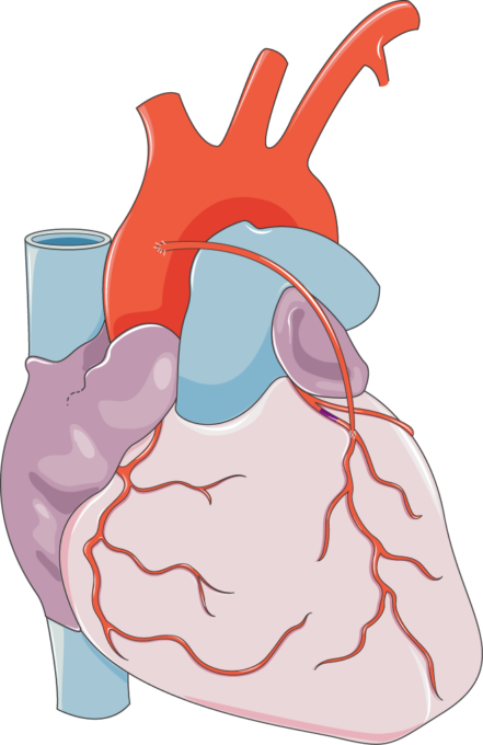 Coronary Artery Bypass Grafting (CABG) $4,500