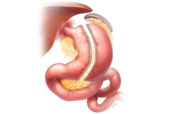 Sleeve Gastrectomy $5500