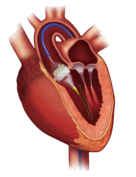 Aortic Valve Repair / Replacement (AVR) $7000-$9000