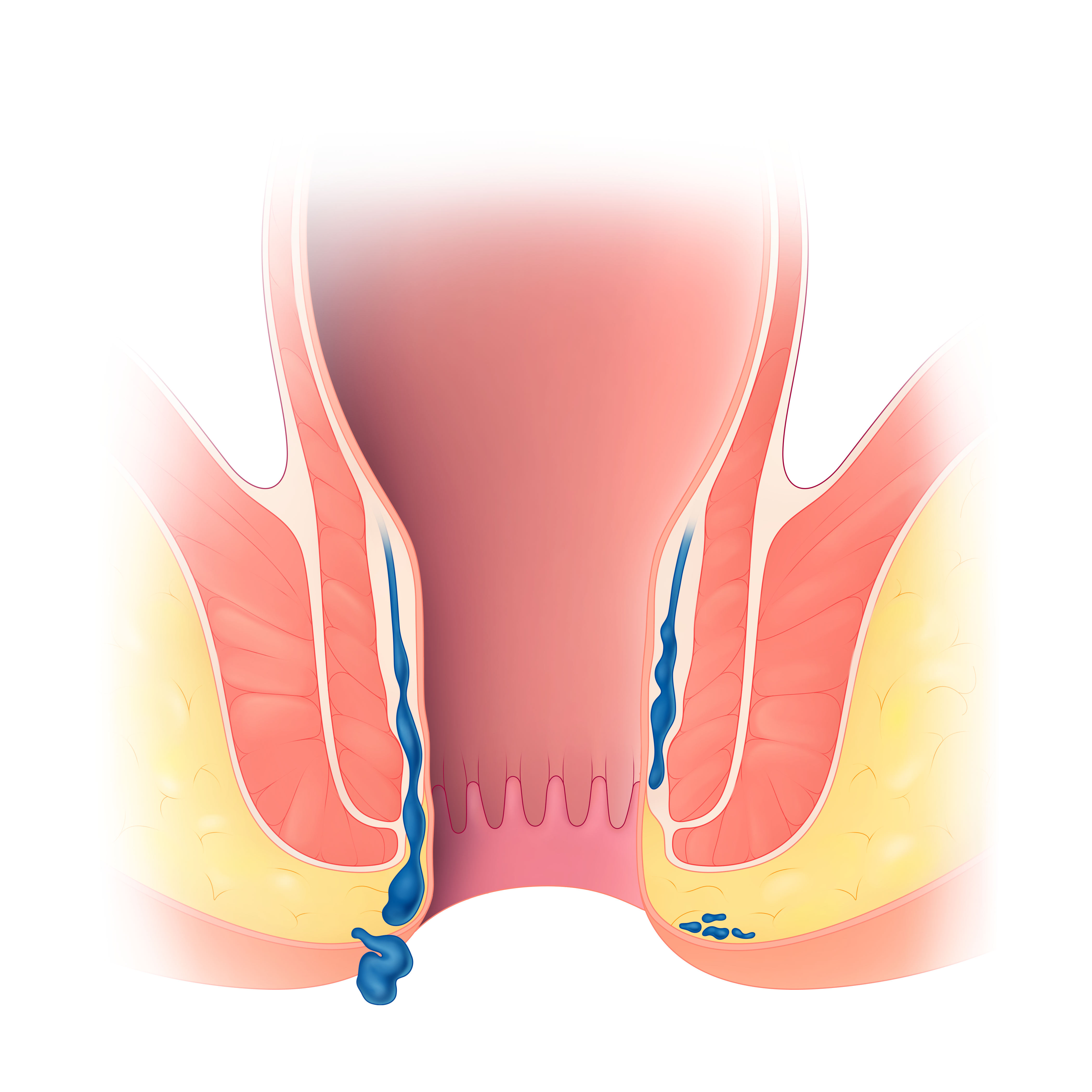 Haemorrhoids Surgery $2000