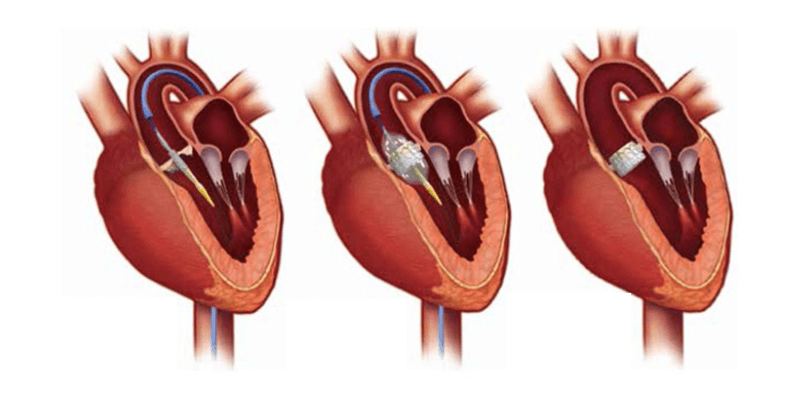 Transcatheter Aortic Valve Replacement (TAVR) $30000