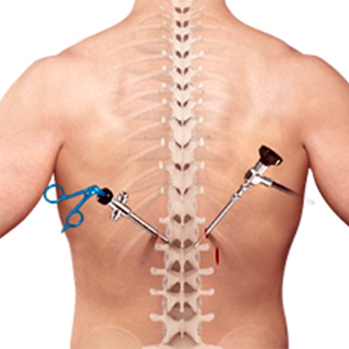 Minimally Invasive spine surgery $5000