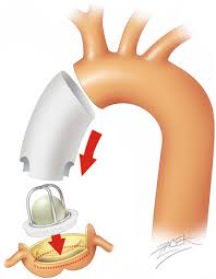 Bentall Surgery $13000-$14000