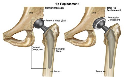 Hip Replacement $5500-$6000