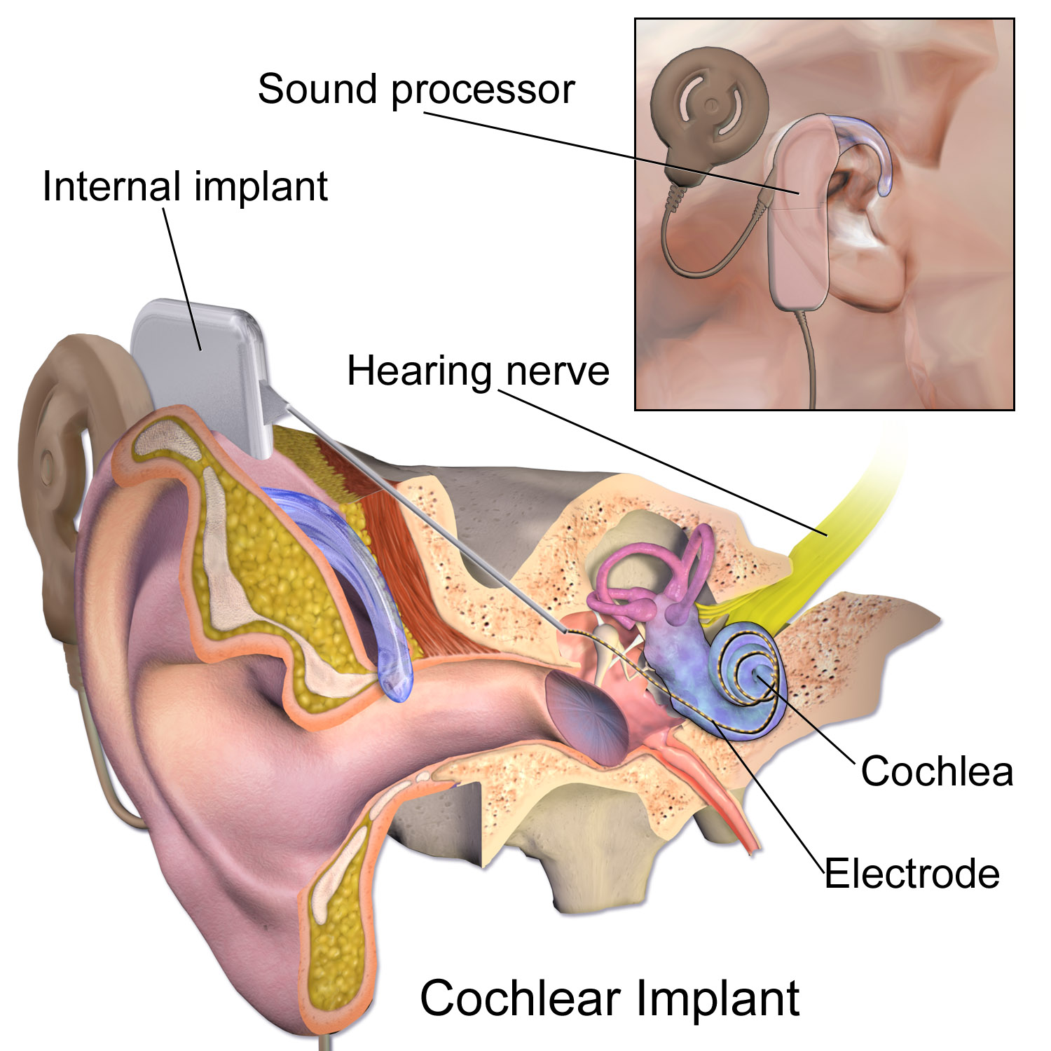 Cochlear Implant $16000