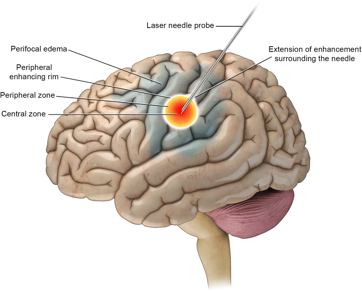 Brain lazer Guided Surgery