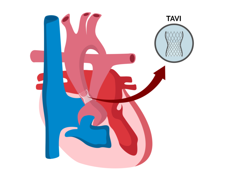 Transcatheter Aortic Valve Implantetion (TAVI) $30000