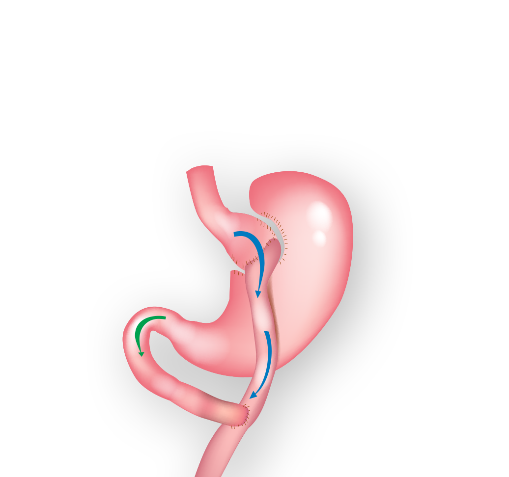 weight loss Surgery / Bariatric Surgery $6000