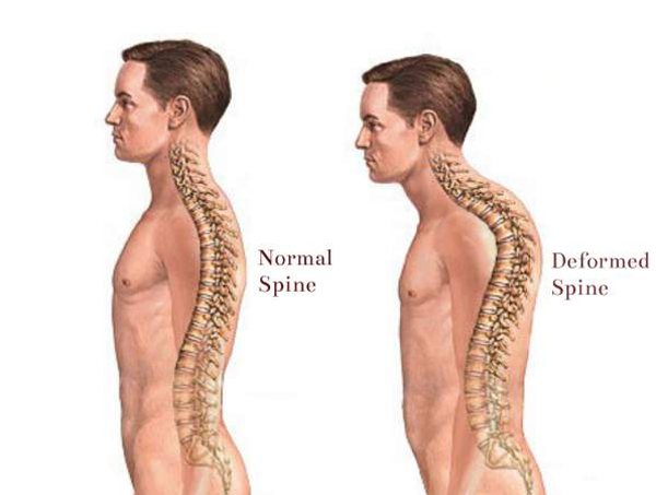 Scoliosis & Deformity Correction $14000